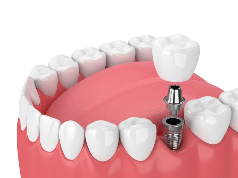 抜歯即時埋入手術が適応不可でも手術当日に仮歯を装着することが可能です