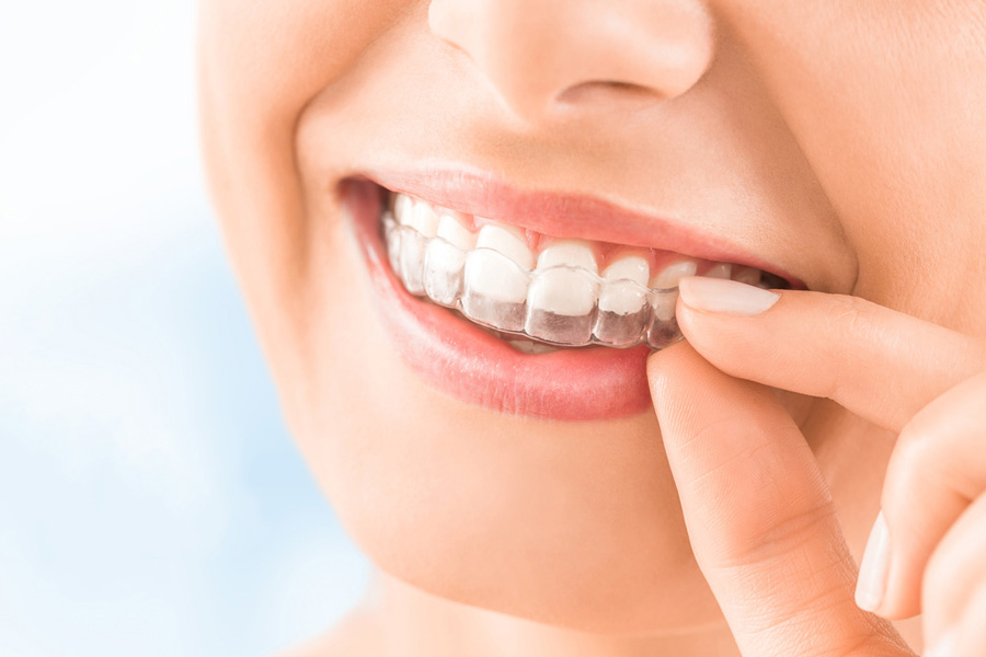 歯の白さと輝きを追求するホワイトニング：オパールエッセンス